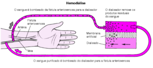 Infográfico processo de Hemodiálise